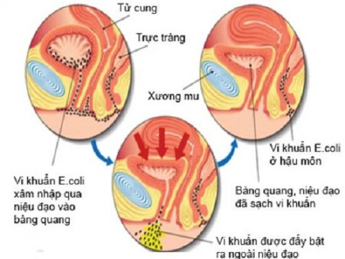 Spasless giảm đau bụng dưới cho thai phụ viêm tiết niệu