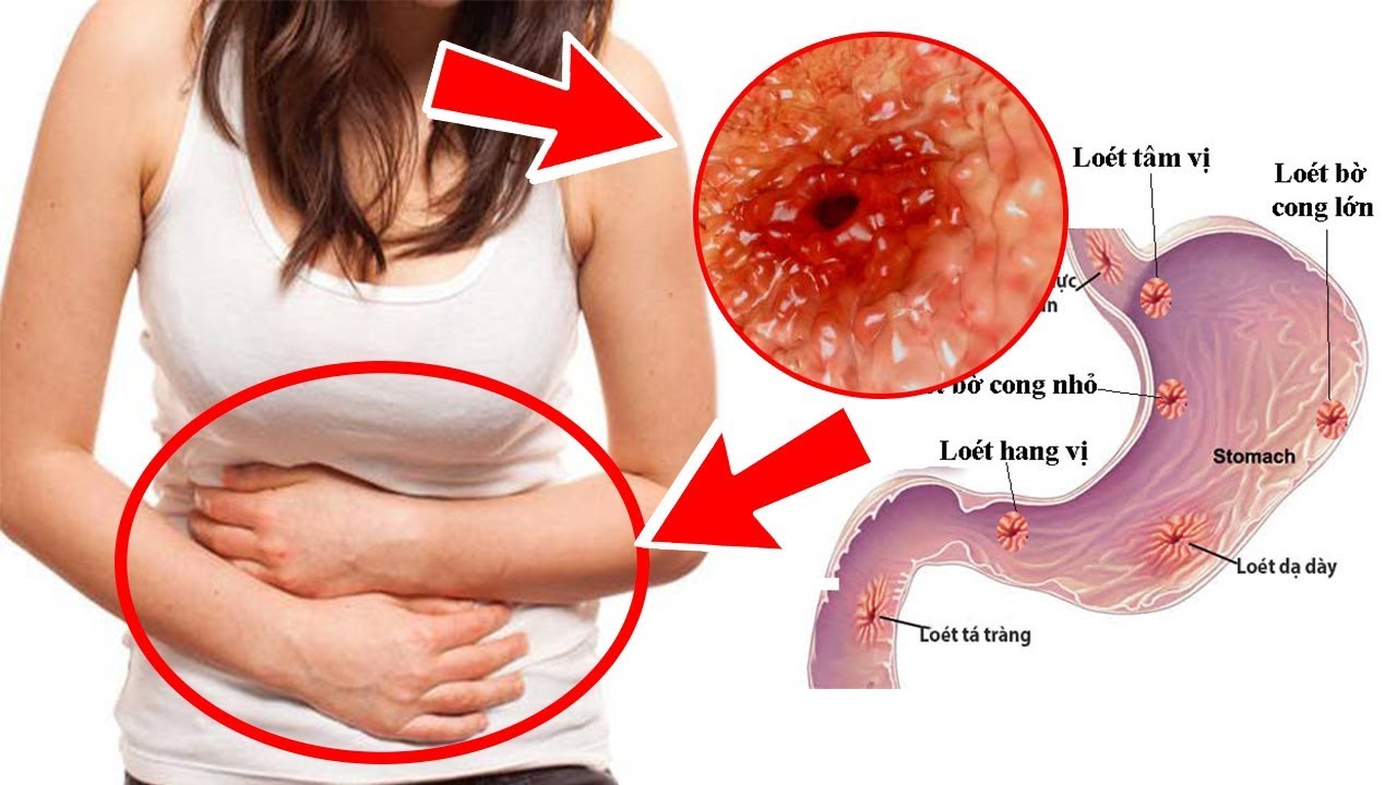 Loét dạ dày ở người cao tuổi – Căn bệnh âm thầm nhưng nguy hiểm