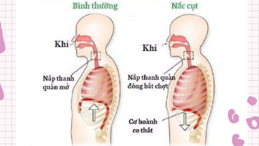 Liều thuốc nấc cụt Liều thuốc nấc cụt
