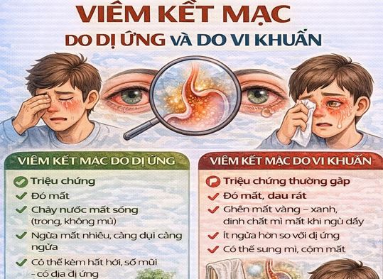 Phân biệt viêm kết mạc do dị ứng và viêm kết mạc do vi khuẩn liều thuốc điều trị tham khảo Phân biệt viêm kết mạc do dị ứng và viêm kết mạc do vi khuẩn liều thuốc điều trị tham khảo