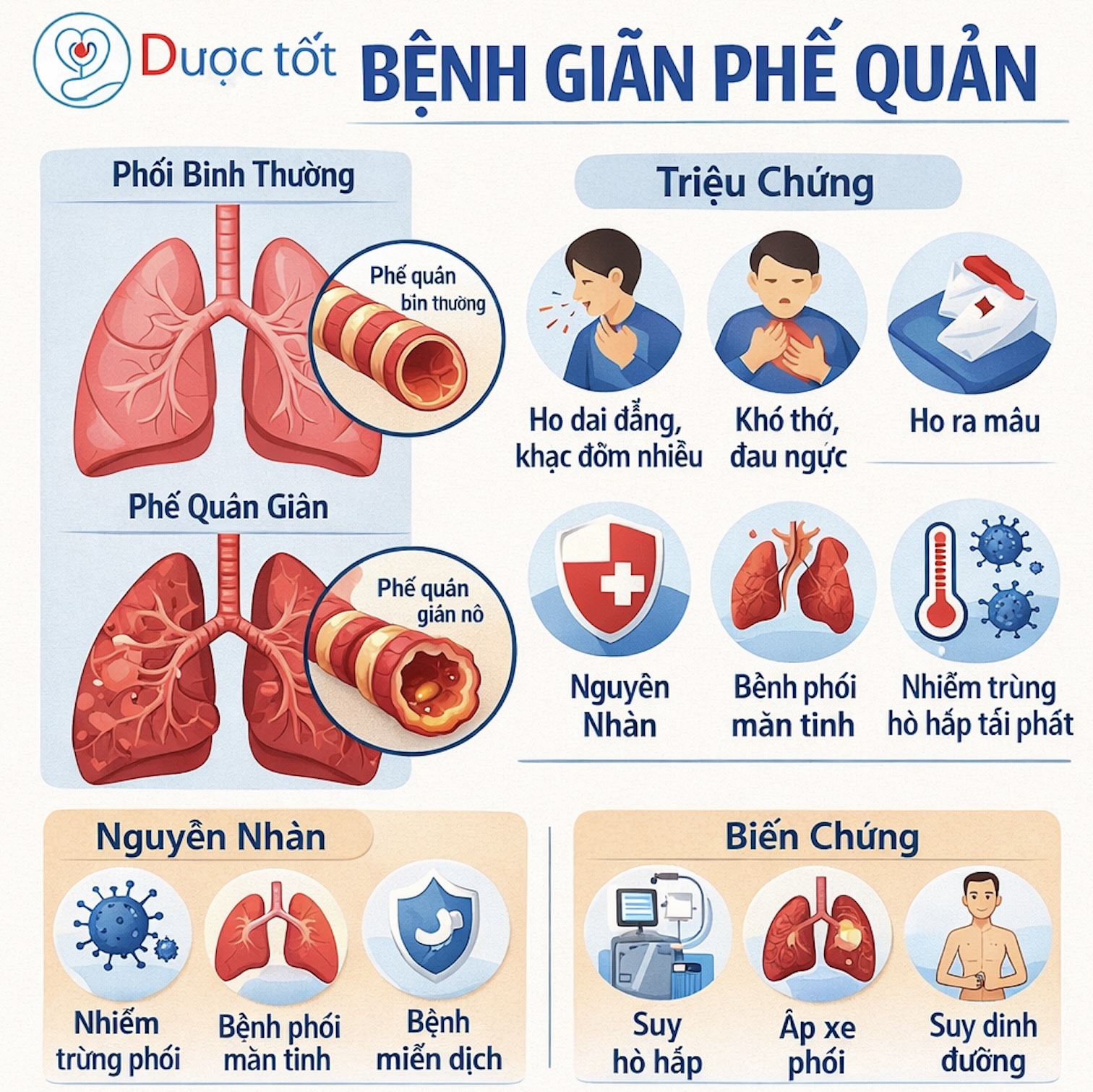 Điều trị bệnh Giãn phế quản Điều trị bệnh Giãn phế quản