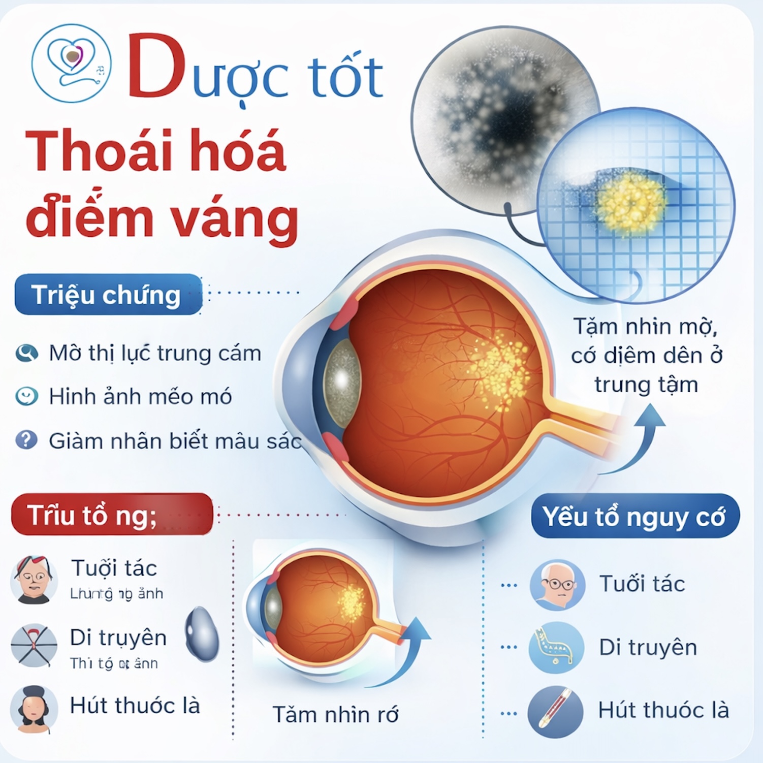 Thoái hóa điểm vàng là gì?