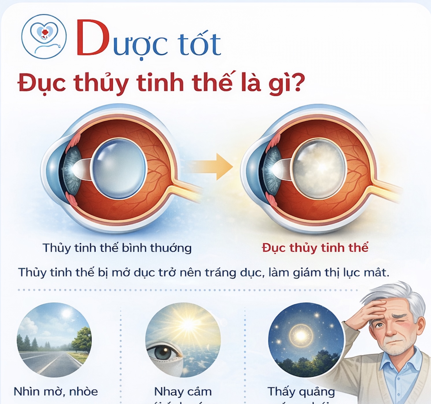 Đục thủy tinh thể là gì?
