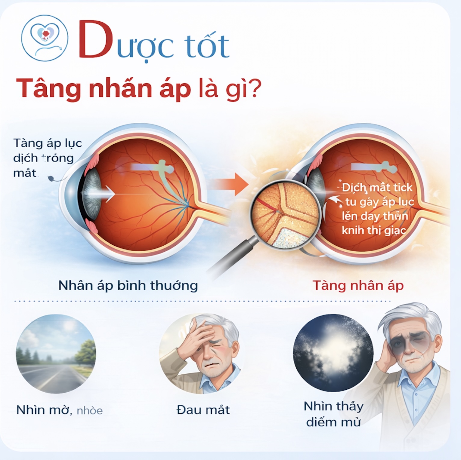 Tăng nhãn áp là gì?