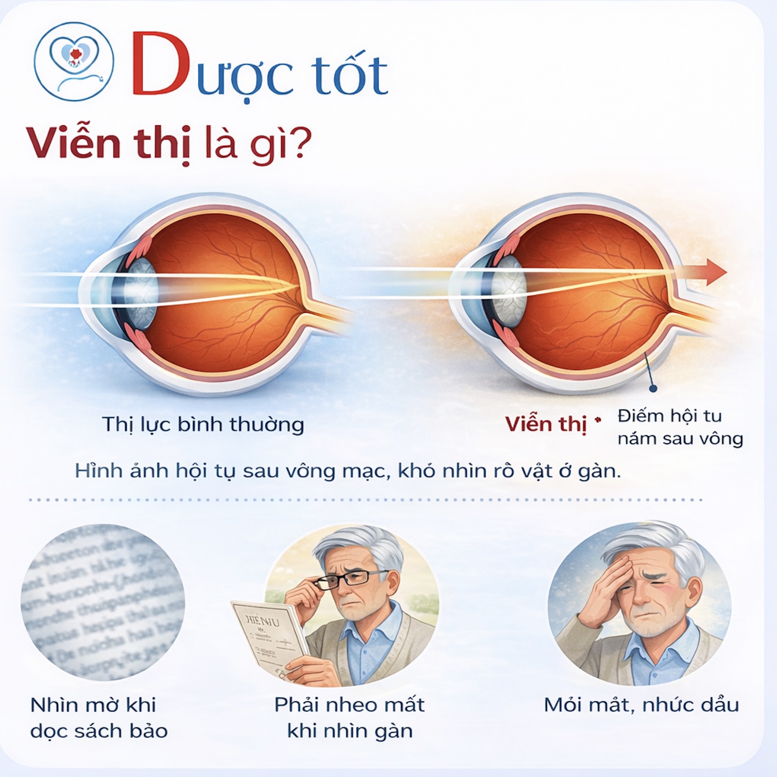 Viễn thị là gì? Viễn thị là gì?