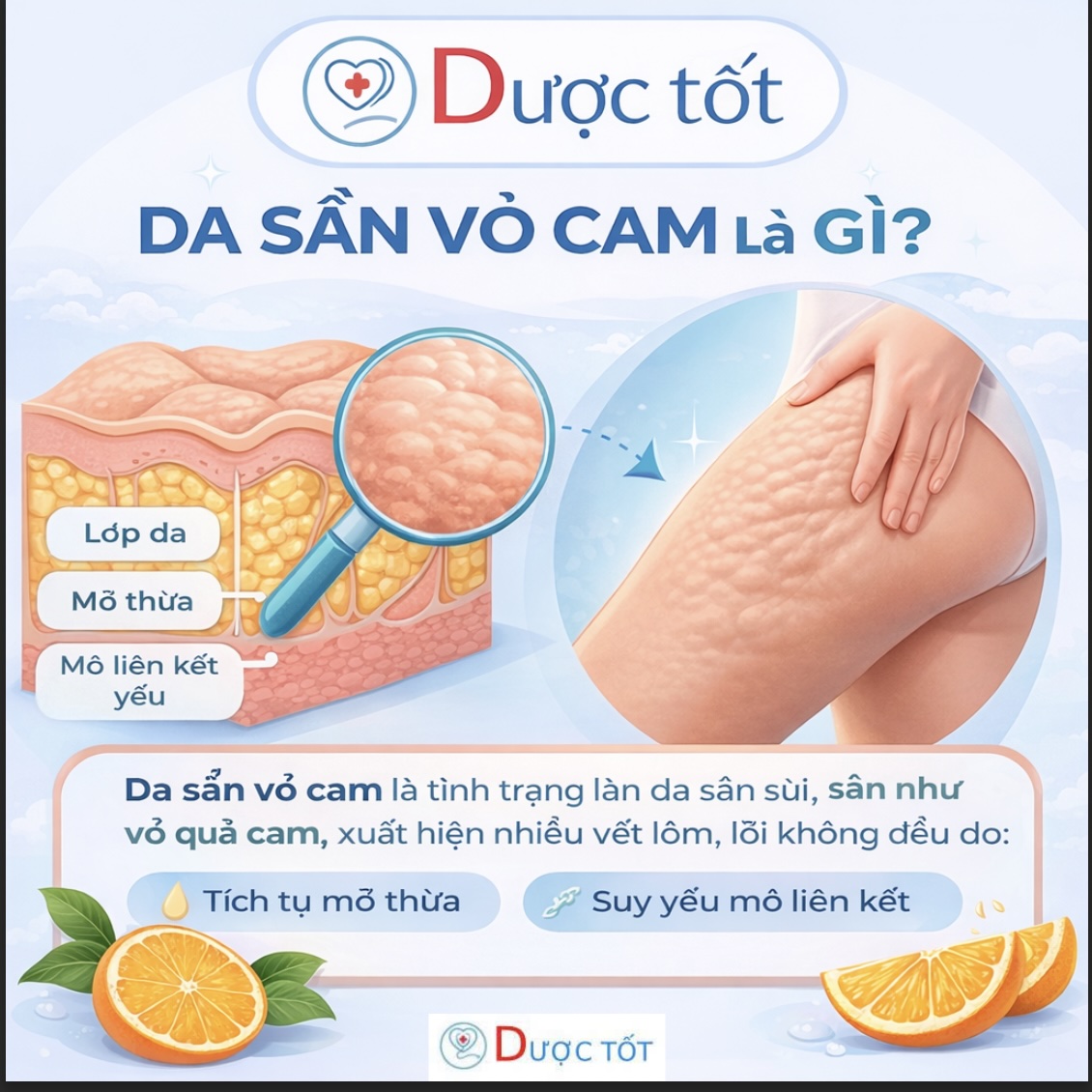 Da sần vỏ cam là gì?