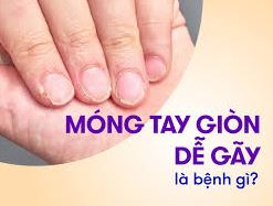 Nhận biết và bổ sung kẽm tránh gây móng giòn dễ gãy