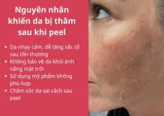 Kích ứng sau peel/retinol - Nhận biết và xử lí đúng cách