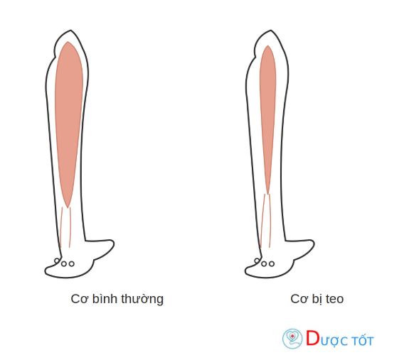 Teo cơ là gì? Nguyên nhân, triệu chứng và cách điều trị hiệu quả