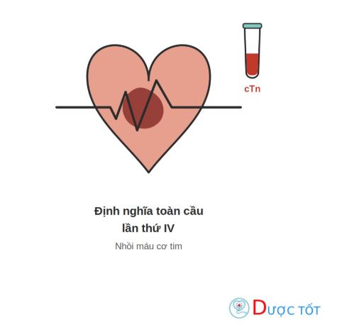 Định nghĩa toàn cầu lần thứ IV về nhồi máu cơ tim