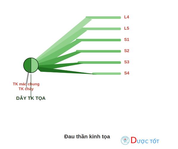 Đau thần kinh tọa: Nguyên nhân, triệu chứng, điều trị