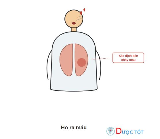 Ho ra máu: Nguyên nhân, chẩn đoán và cách xử trí