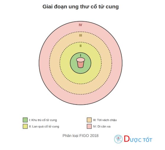Triệu chứng và chẩn đoán ung thư cổ tử cung