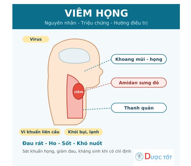 Viêm họng: nguyên nhân, triệu chứng và cách điều trị đúng