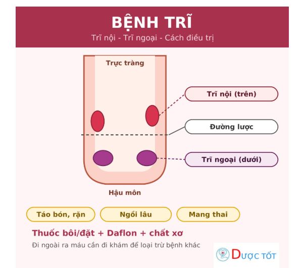 Bệnh trĩ: trĩ nội, trĩ ngoại và cách điều trị bằng thuốc