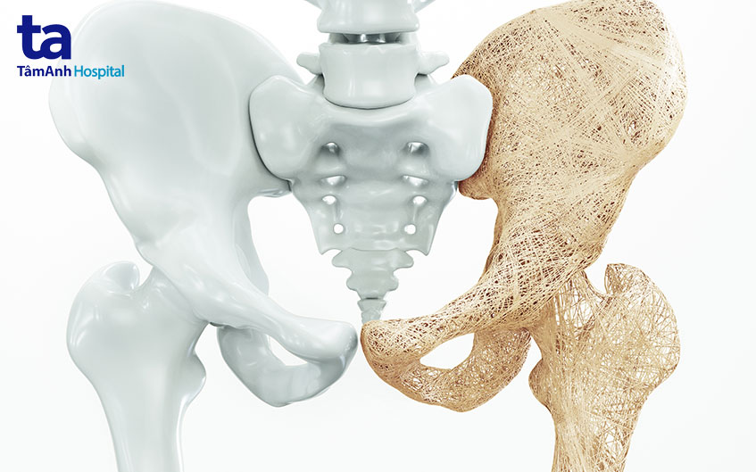 Loãng xương ở người cao tuổi – “Sát thủ thầm lặng” gây gãy xương và tàn phế