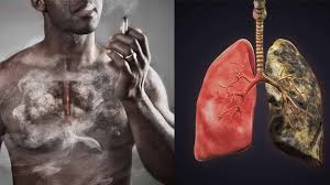 Ung thư phổi và thói quen hút thuốc: Hiểm họa từ khói thuốc mỗi ngày