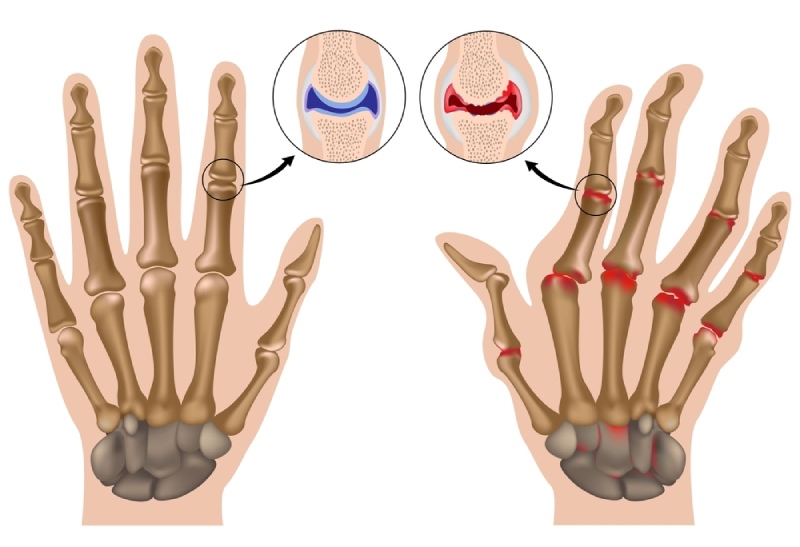 Thoái hóa khớp – Khi xương khớp “lên tiếng”