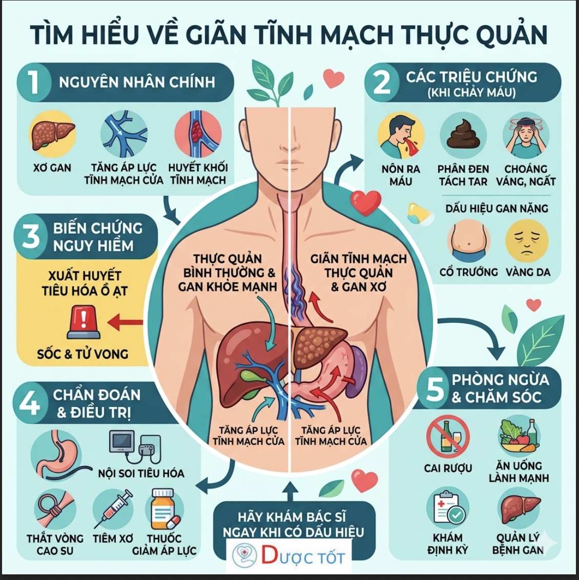 Giãn Tĩnh Mạch Thực Quản Là Gì