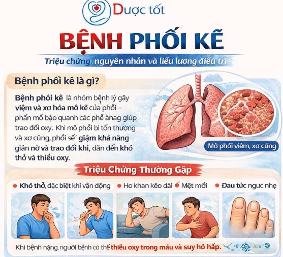 Interstitial Lung Disease (bệnh phổi kẽ) & Cách điều trị