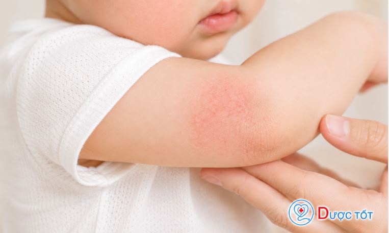Viêm da cơ địa ở trẻ em – Nguyên nhân và cách điều trị 