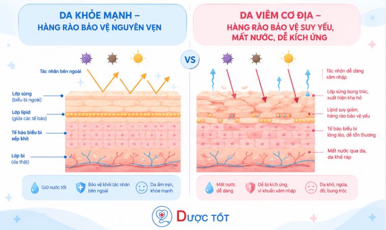 Nguyên nhân viêm da cơ địa ở trẻ em