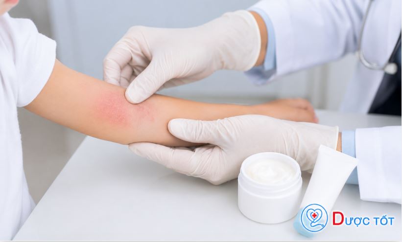 Điều trị viêm da cơ địa ở trẻ em