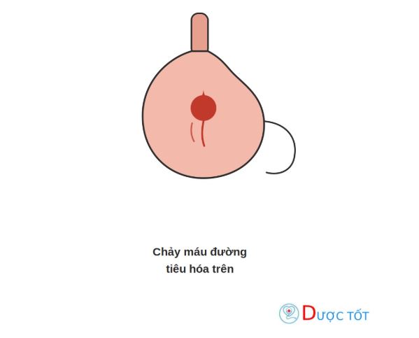 Chảy máu đường tiêu hóa trên: Nguyên nhân, xử trí
