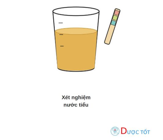 Xét nghiệm nước tiểu trong niệu khoa: Quy trình lấy mẫu