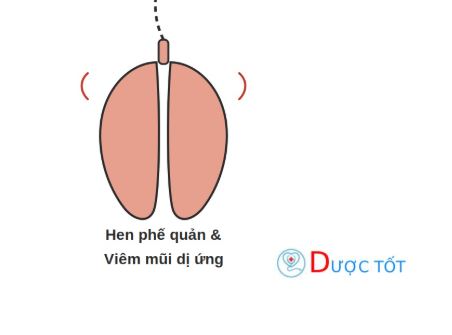 Hen phế quản và viêm mũi dị ứng: Mối liên quan cần biết