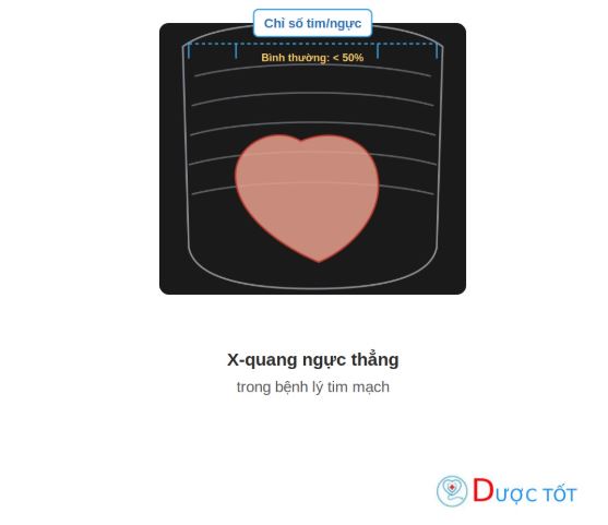 X-quang ngực thẳng trong bệnh lý tim mạch