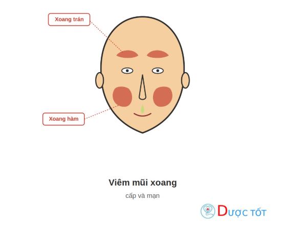 Viêm mũi xoang cấp và mạn: Triệu chứng, cách phân biệt