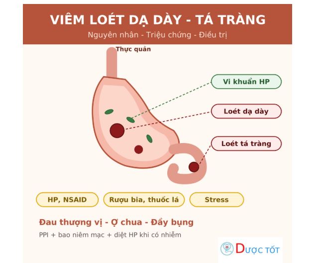 Viêm loét dạ dày tá tràng: triệu chứng và cách điều trị