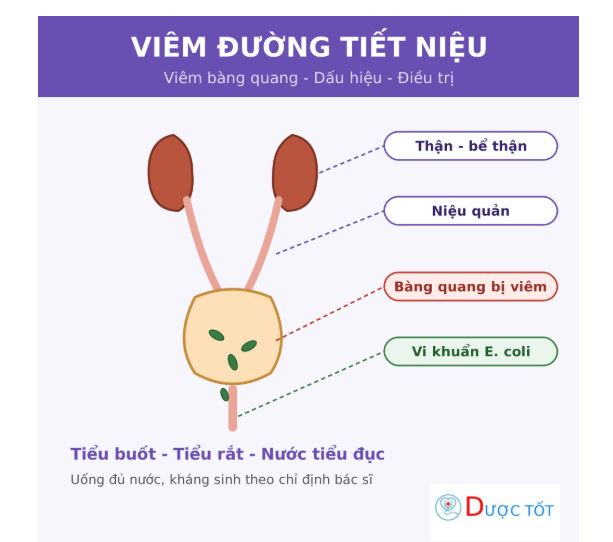 Viêm đường tiết niệu: dấu hiệu và cách điều trị đúng