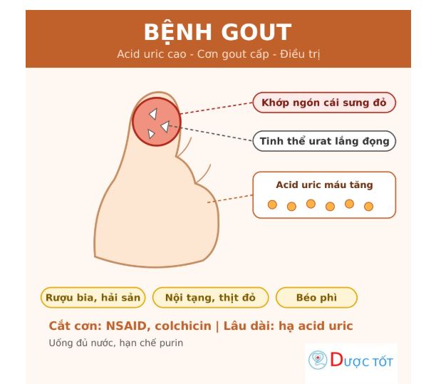 Bệnh gout: triệu chứng, nguyên nhân và cách điều trị