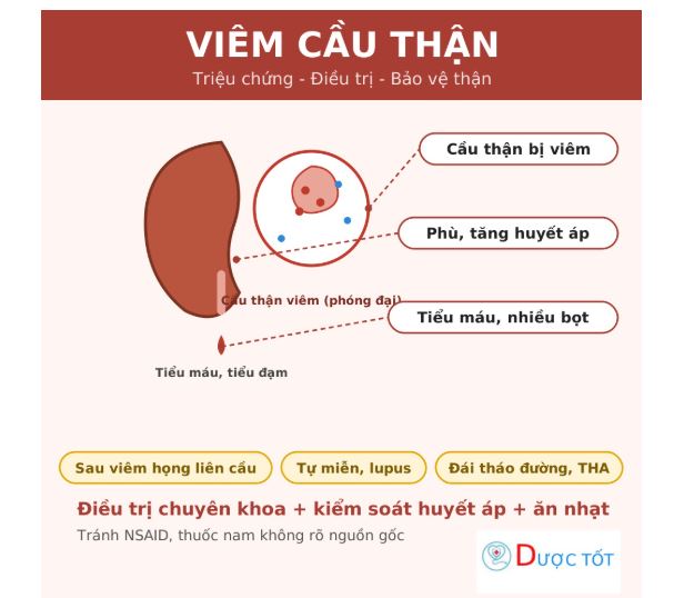 Viêm cầu thận: triệu chứng, nguyên nhân và hướng điều trị