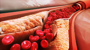 Bệnh tim mạch ở người cao tuổi – Kẻ giết người thầm lặng