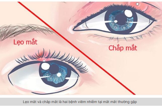 Liều thuốc tây Chắp - Lẹo mắt (Tham khảo)